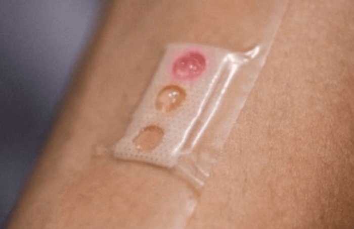 Tecnología microláser para captar biomarcadores en el sudor